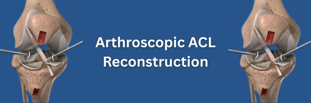Arthroscopic ACL Reconstruction