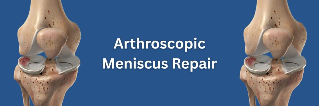 Arthroscopic Meniscusa Repair