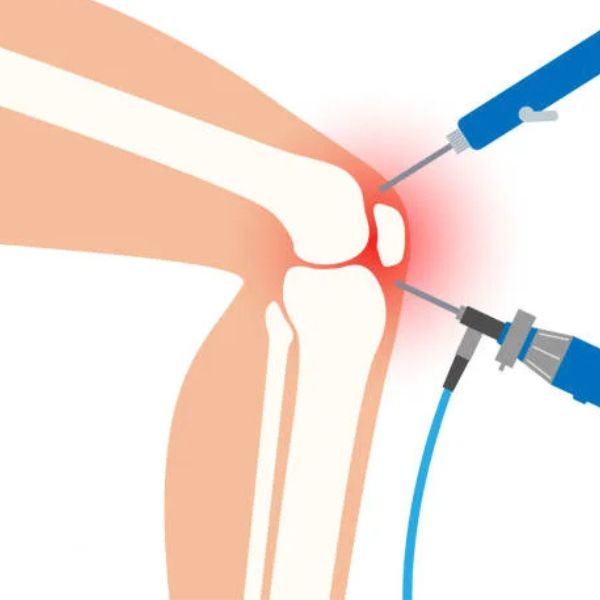 Arthroscopic Osteochondral Allograft Transfer