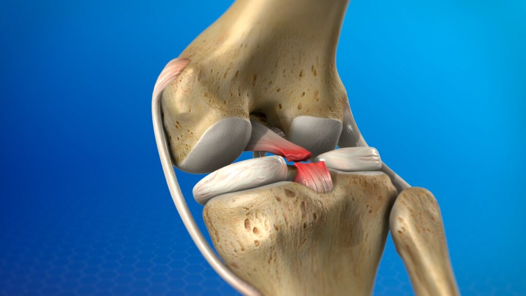 Arthroscopic PCL Reconstruction