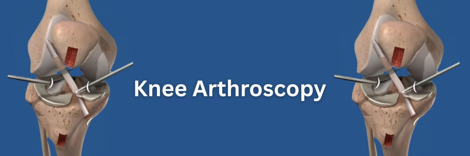 Knee Arthroscopy