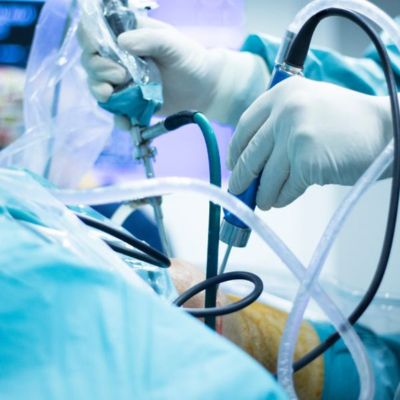 knee arthroscopy (1)